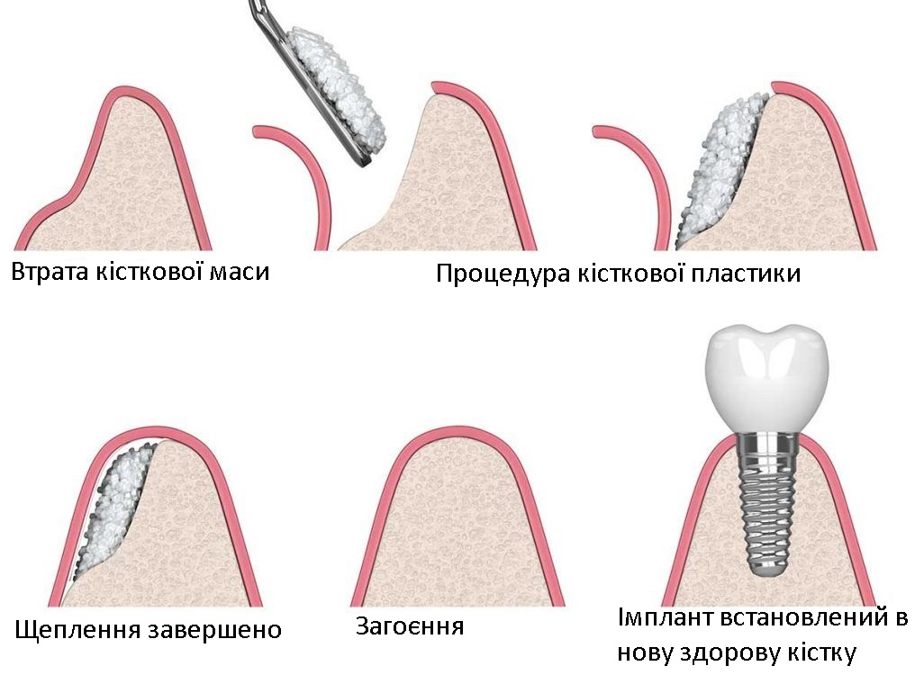 Кісткова пластика ≡ Нарощування кісткової тканини зубів • Ціна