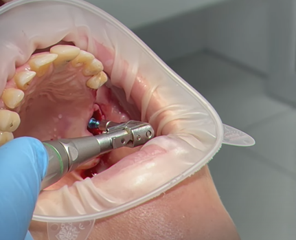 Хирургический этап имплантации зуба