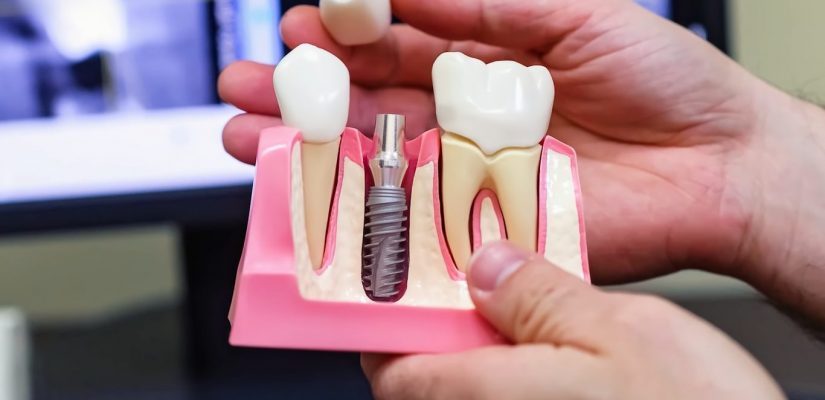 что такое имплантация зуба