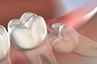 Удаление зубов мудрости в dental tech