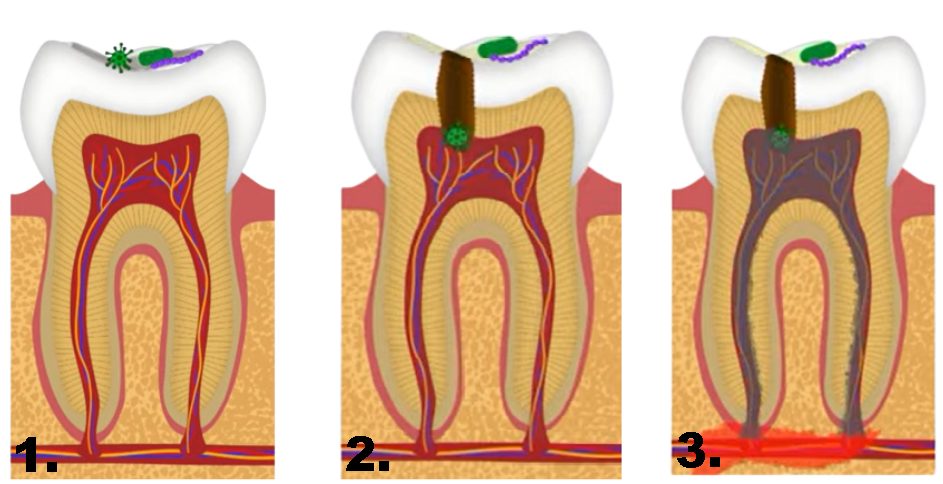 зубні канали