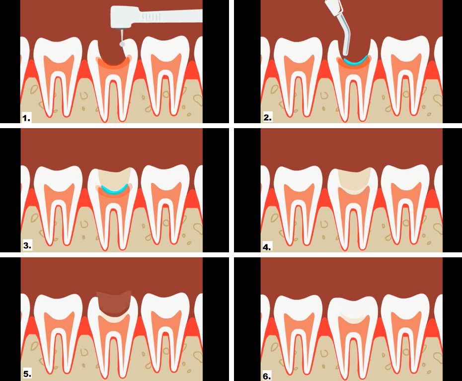 чистка каналов зубов