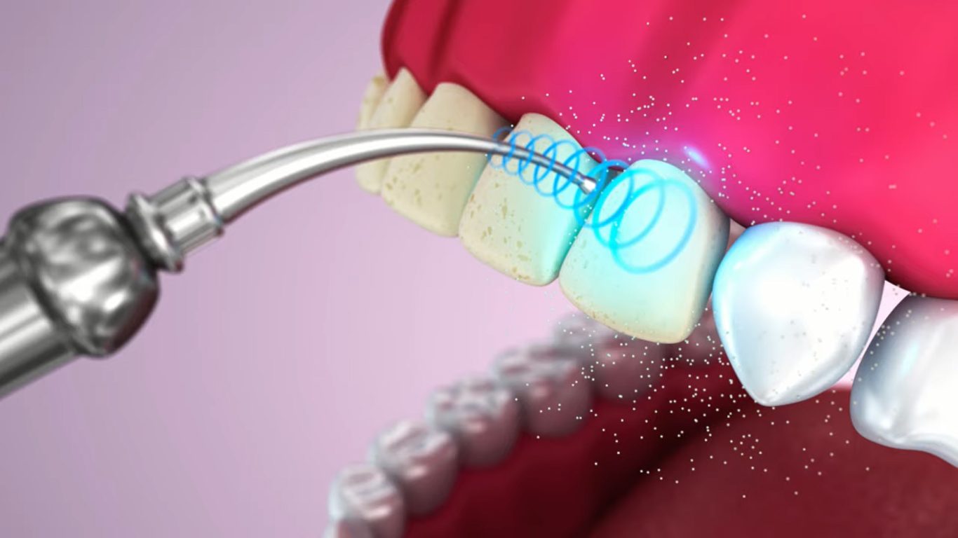 Проф. чистка зубов ультразвуком