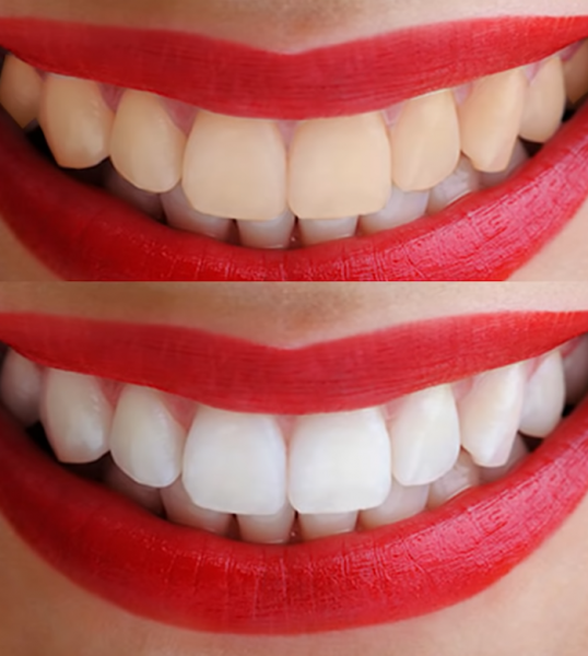 до і після, відбілювання зубів