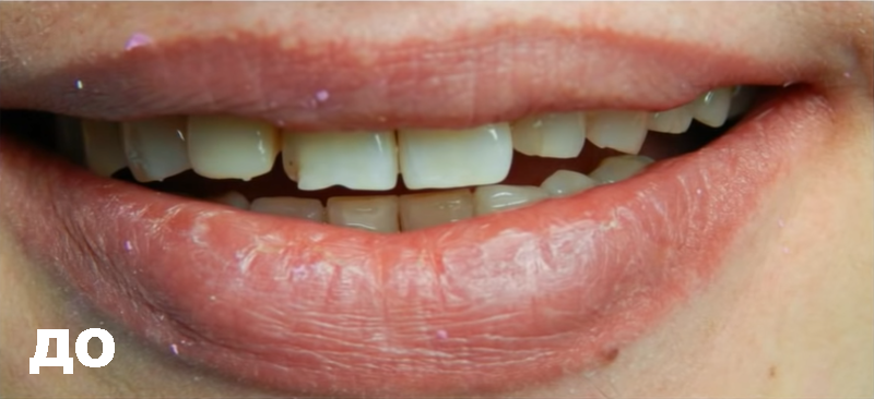czyrkonyevaya koronka na zub do operaczyy