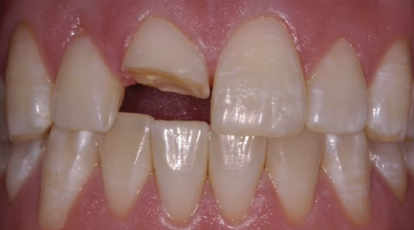 Показання до встановлення коронки на зуб
