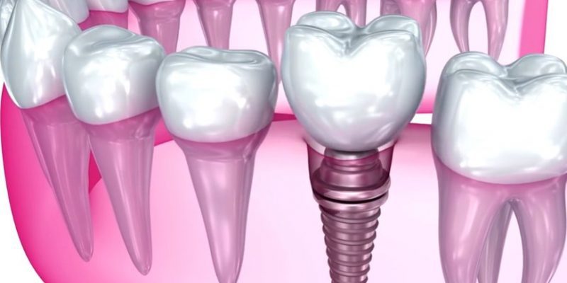 одноетапана імплантація зубів