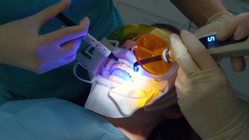 Як проходить процедура відбілювання зубів, етап 2