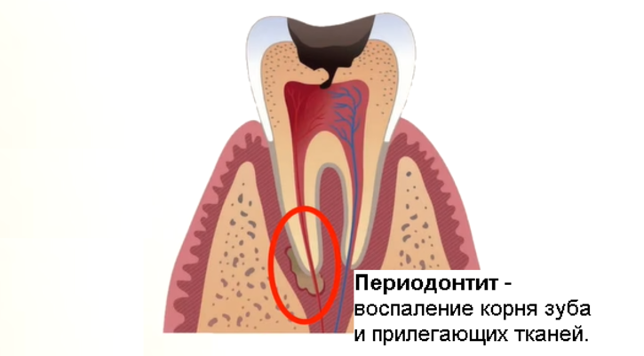 Показання на перелікування каналів зуба