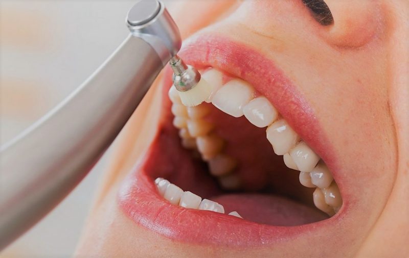 Професійне чищення зубів