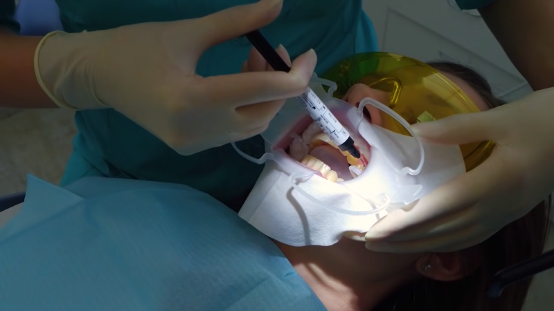 Как проходит процедура отбеливания зубов, этап 1