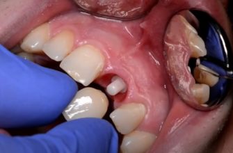 протезування зубів в Дніпрі