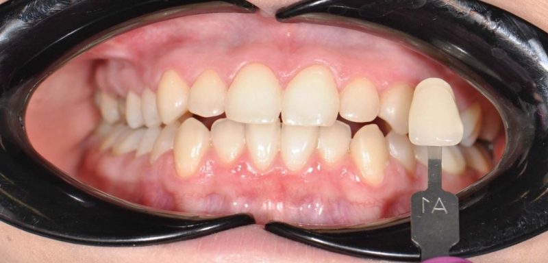 Як проходить процедура відбілювання зубів, етап 6