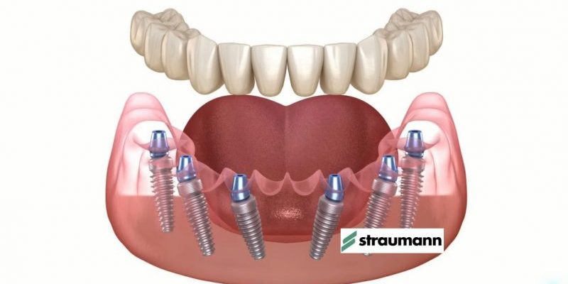 зубной имплант Штрауман