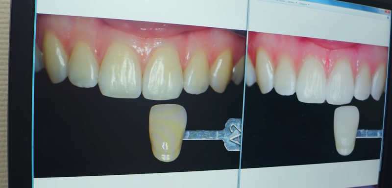 Как проходит процедура отбеливания зубов, этап 5