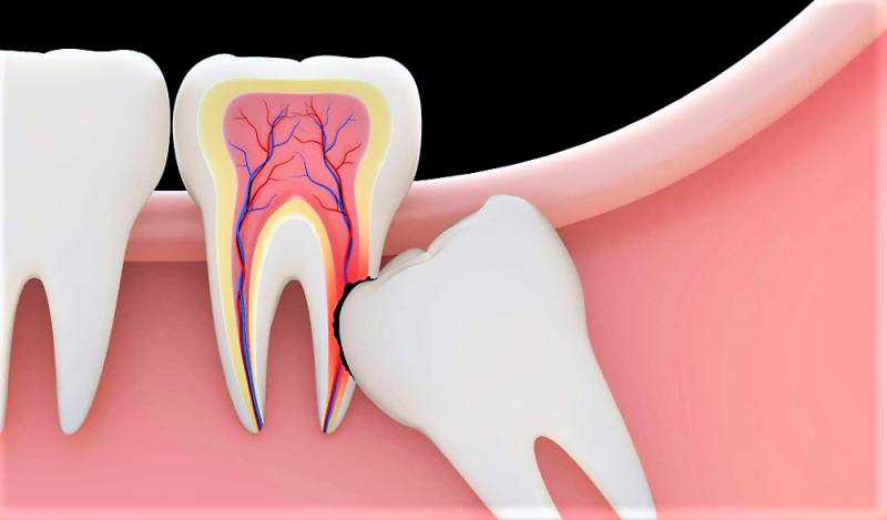 Зуб мудрости – лечить или удалять?