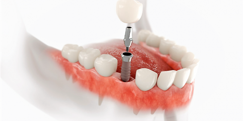 Імплантація зуба