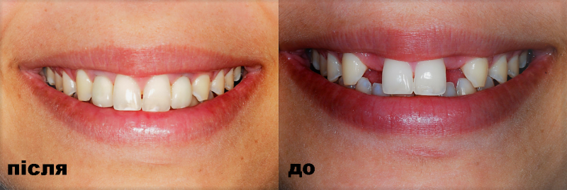 Імпланти зубів, до і після