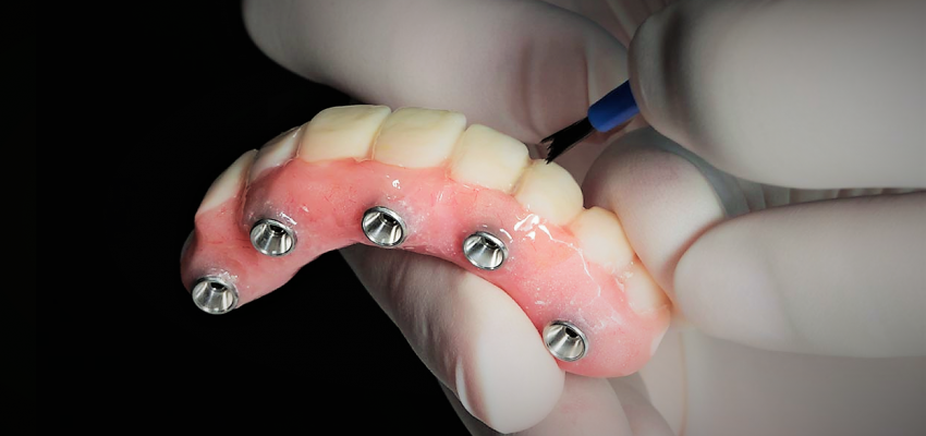 Імпланти зубів. плюси та мінуси