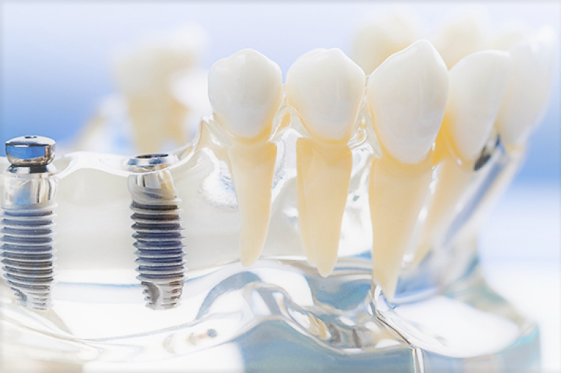 мінуси імплантації зубів