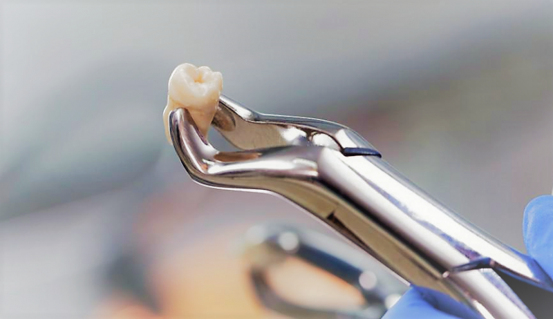 переваги імплантації зуба мудрості