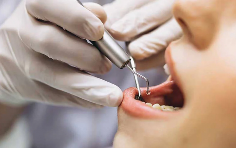 Підготовка до процедури видалення нерва зуба