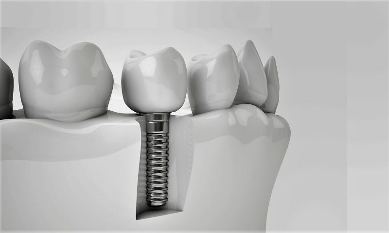 Види зубних імплантів