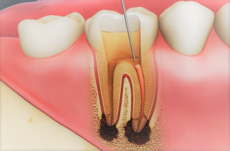 Видалення зубного нерва без болю