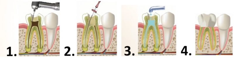 Как удаляют нерв в зубе