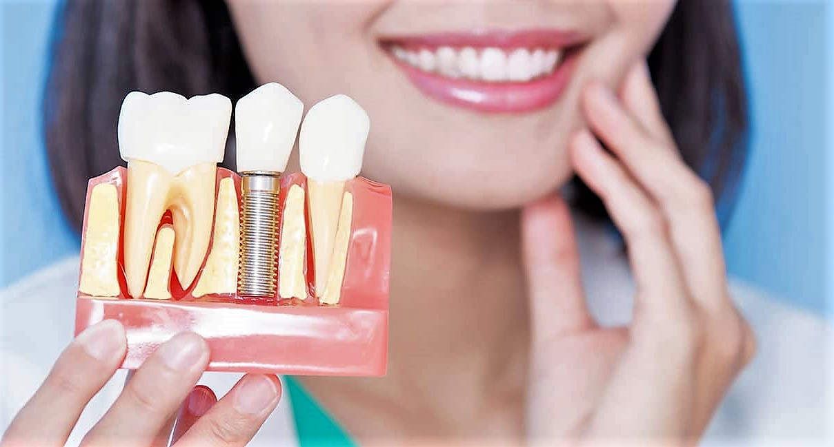 Зубний імплант не прижився - Що робити? - Dental Tech
