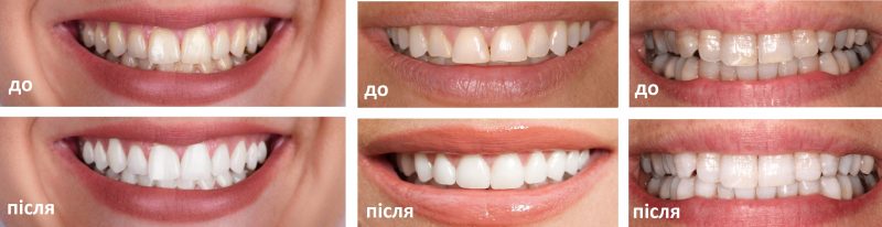 Реставрация зубов: фото до и после 